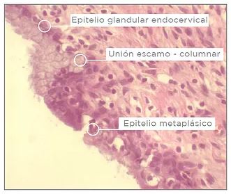 Metastatický skvamózní epitel vychází z diferenciace a proliferace zárodečných buněk a je optimálním terčem pro vstup infekce viry HPV