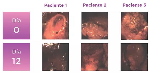 Kolposkopické vyobrazení 3 pacientek před a po aplikaci Papilocare ukazují změny v epitelizaci děložního krčku. 